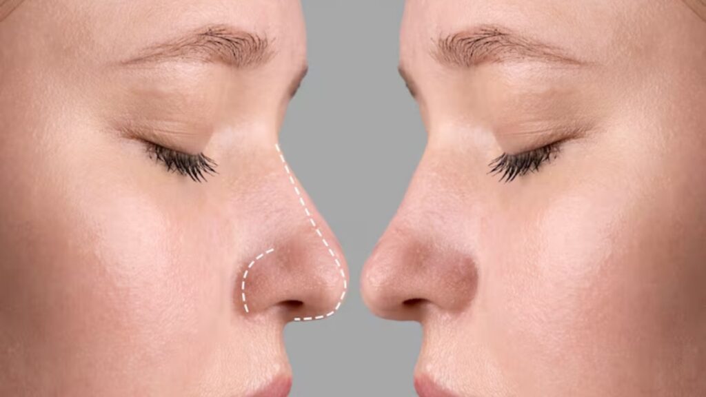 Especialista comenta os benefícios da rinoplastia (Freepik)