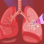 Tuberculose pode ser fatal; veja dicas de como se prevenir (Foto: USP)